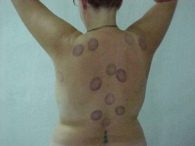 SGK gets Ringworm!!!! (Vietnam, The Travel Addicts)