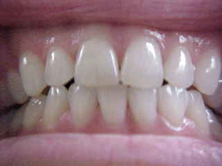 The teeth of a dental hygienist : (look good enough Dr. Syn???) (The Travel Addicts, Thailand)